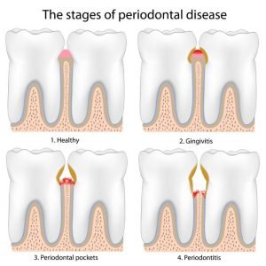 Gum Disease and Braces