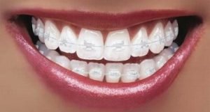 Ceramic braces