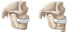 Orthognathic Surgery