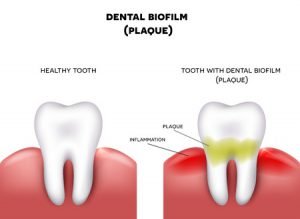 Gum Disease and Braces